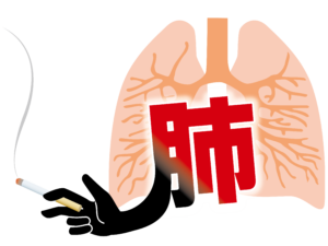 肺気腫